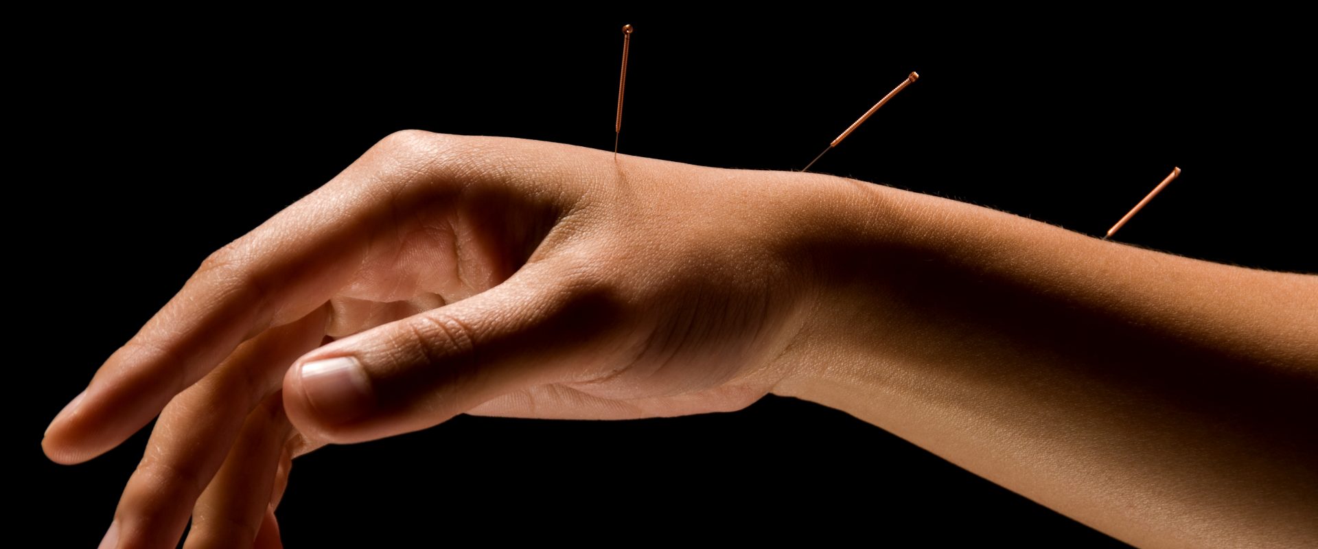 Does Acupuncture Hurt?