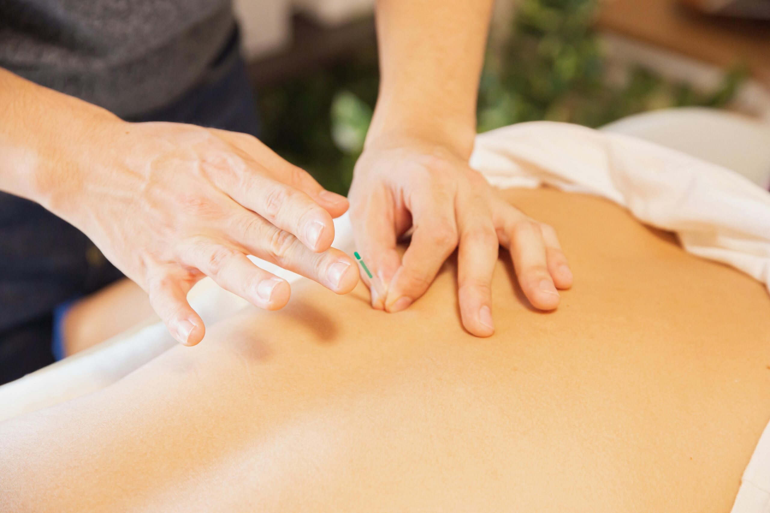 Dry Needling Vs Acupuncture- Is there a Difference?